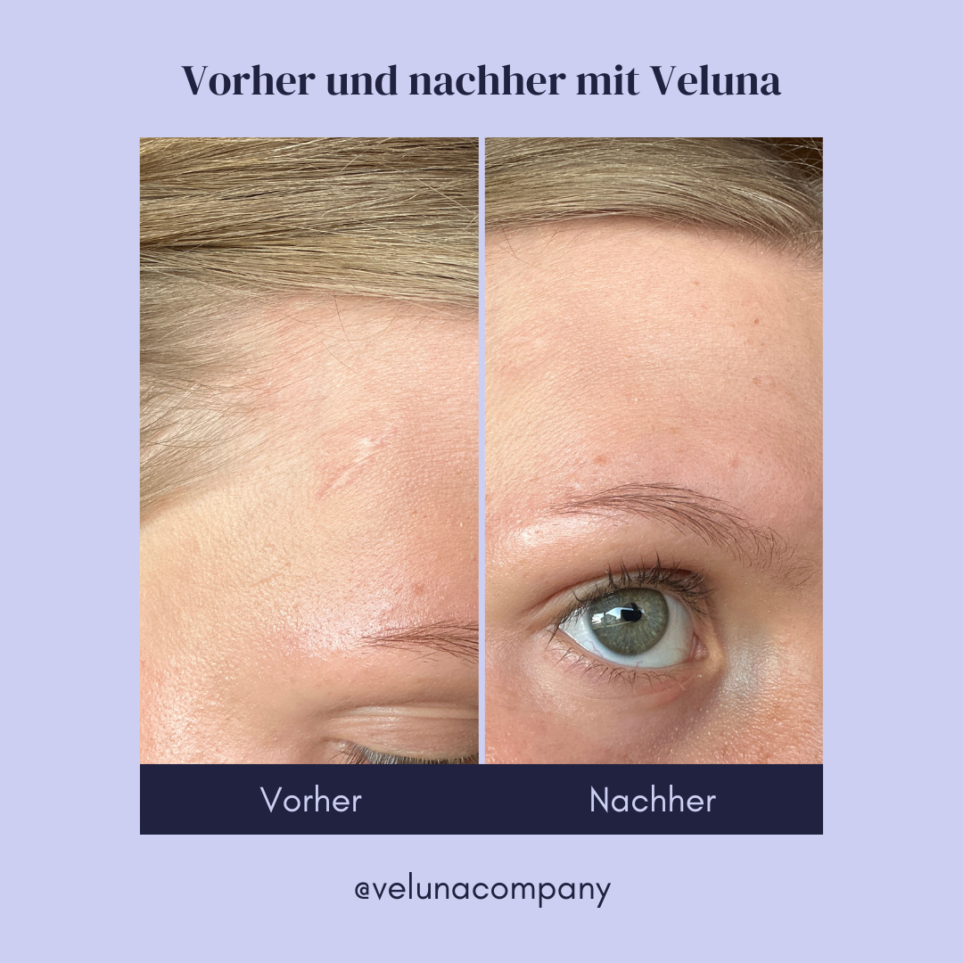 Veluna Silikon-Narbenpflaster™